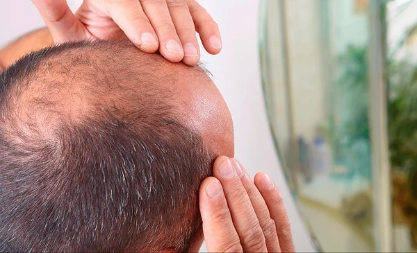 Día Mundial de la Calvicie: Opciones efectivas para combatir la caída del cabello